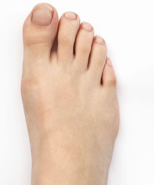 J'ai traité mon valgus du pouce avec le spray Hondro Sol Valgus