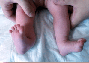 Déformation valgus dans les symptômes des enfants