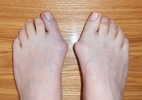 Facture sur les jambes