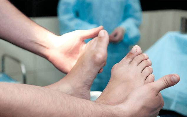 Valgus de déformation du pied