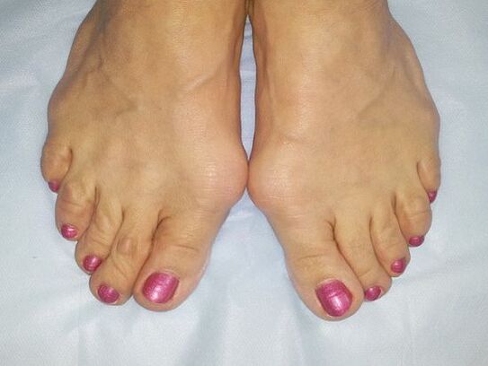 Hallux valgus des pieds