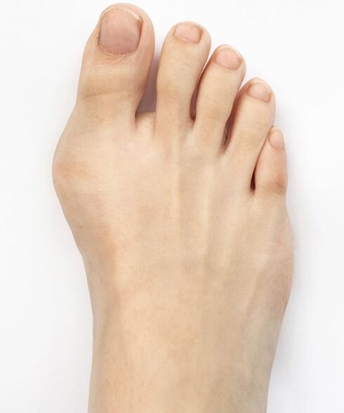 hallux valgus avant d'utiliser le spray Hondro Sol Valgus